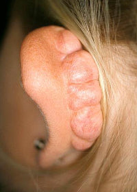 Keloid Scarring after failed otoplasty
