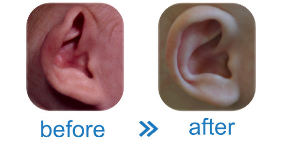 baby's ear has 2 deformities: Stick-Out Ear + Stahl's Ear