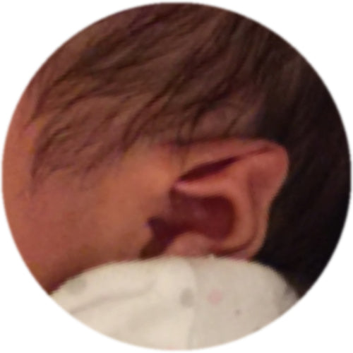 This Malformation of the outer ear is known as a Stahl's Bar