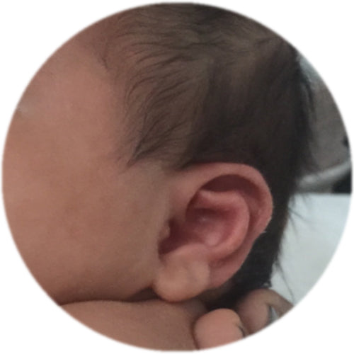 Ear Buddies Infant Auricular Correctors can treat a Stahl's Bar in Babies