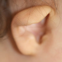 Baby with Lop Ear Deformity | Neonatal Ear Malformations