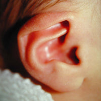 A picture of a baby's ear with lop ear deformity