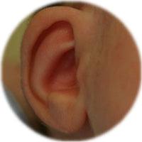 Lop ear corrected with earbuddies without otoplasty ( surgery )