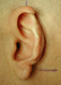 Loss of Auricular Tissue due to surgery can be avoided later in life if ear buddies are fitted to babies