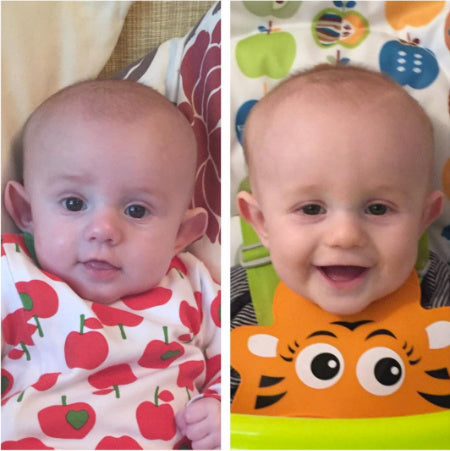 before and after photo & review of ear buddies fixing baby sticky out ears