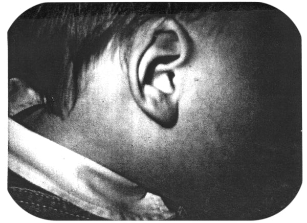 crumpled baby ear fixed with medical device for molding ears