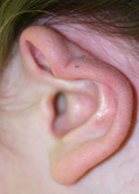 post-op 'm' deformity | ear buddys help avoid the complications of otoplasty later in life
