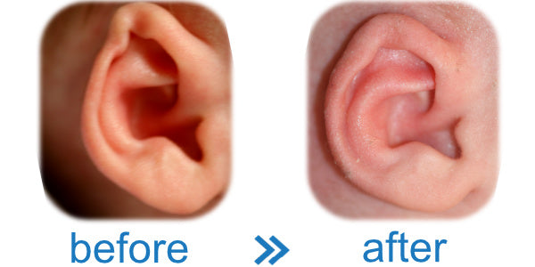 Baby born with kink in ear ? EarBuddies™ is an easy, cheap & effective solution.
