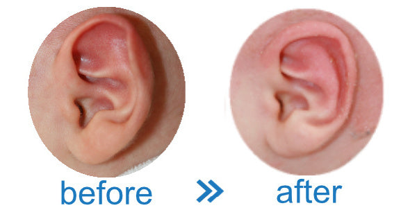 A Before & After Picture of Ear Buddy Splint correcting fold over rim of baby ear