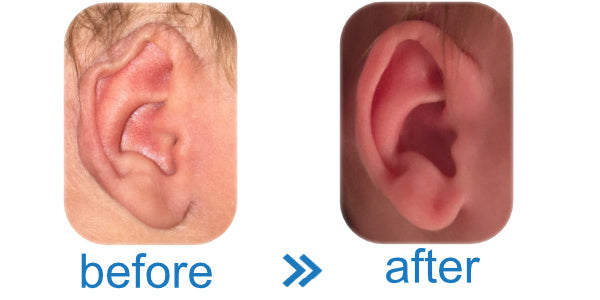 Helical Rim Deformity in babies | correct with ear buddie