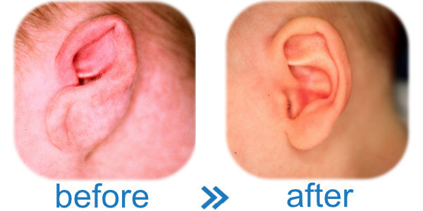 before ear lobe folds over in baby | after photos shows that ear buddies works on baby ears