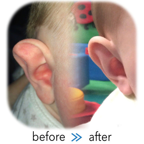 Ear Buddies Splints reshaping a Stahl's Ear