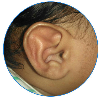 correction of sticking out ears with ear buddies | parent review