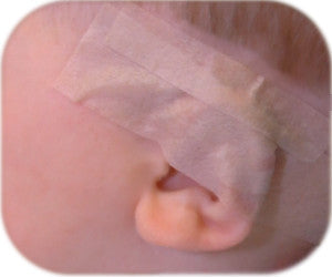 Apply tape to hold the ear buddies splint in place.  Correct stick out ears with neonatal splintage