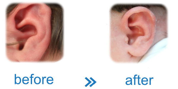 EarBuddies™ can save you the cost of an otoplasty or pinnaplasty ( ear surgery )