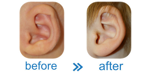 Baby newborn with bend in ear. Easy, cheap, effective solution.