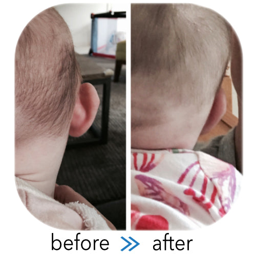 Stick Out Ear viewed from behind the head | before & after Ear Buddies