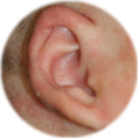 stick out lobe fixed with ear buddies without surgery