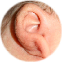 ear lobe before correction with ear buddies cartilage shapers