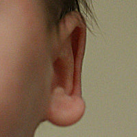 baby has abnormal big ear lobes
