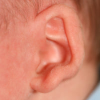 photo of babys ear lobe folding outwards and up