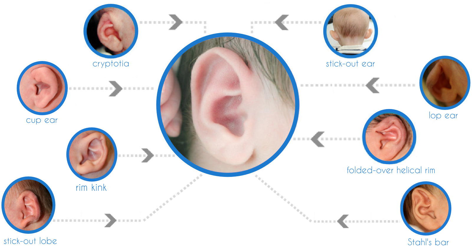 What Ear conditions can Ear Buddies treat? Rim Kink, Stick Out ears, Stahl's Bar, Cup Ear, Rim Kink e.t.c