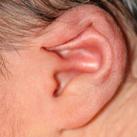 photo of the top of baby's ear folding down