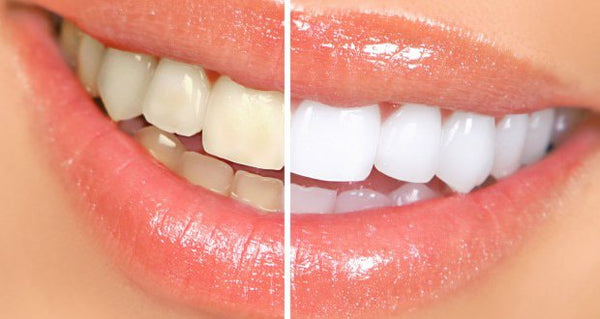 teeth whitening, teeth whitening at home, teeth whitening at home diy, how to make teeth whiter in 3 minutes, how to whiten teeth with baking soda, how to whiten teeth with hydrogen peroxide, how to whiten teeth instantly, diy teeth whitening, diy teeth whitening coconut oil, diy teeth whitening hacks, diy teeth whitening recipe, tlc naturals, tlc naturals online, tlc naturals products, 