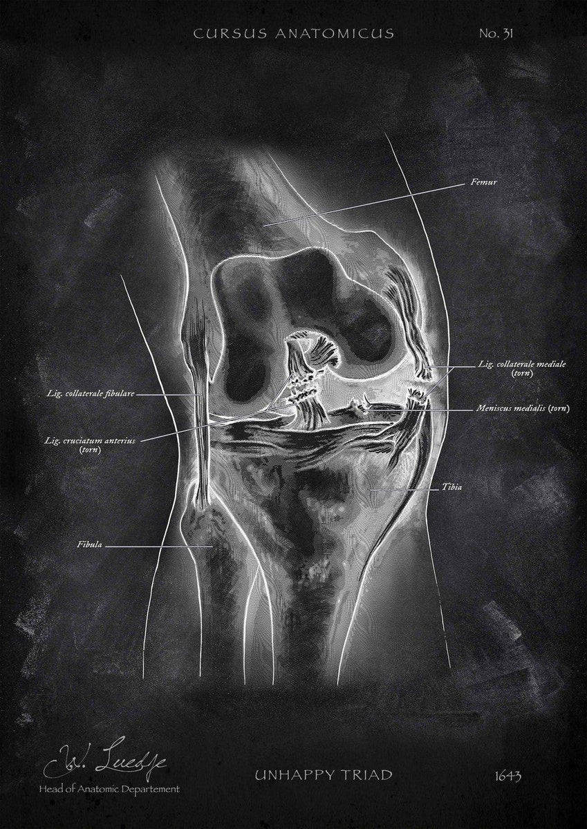 Unhappy Triad Knie Anatomie Poster in Chalk - Cursus Anatomicus