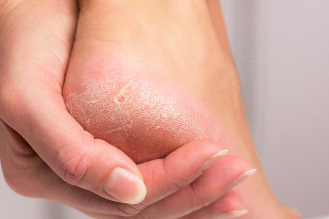 what causes dry skin on our feet