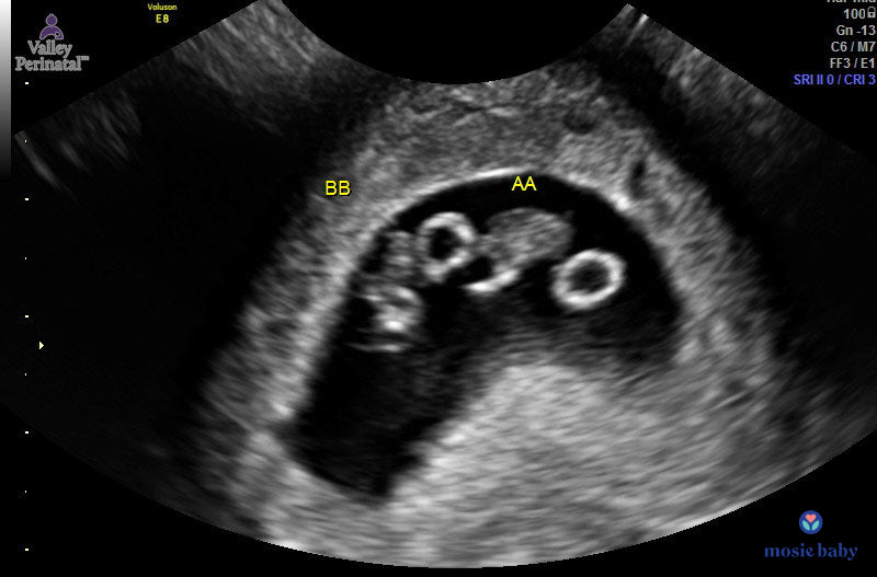 sonogram of mosie baby twins