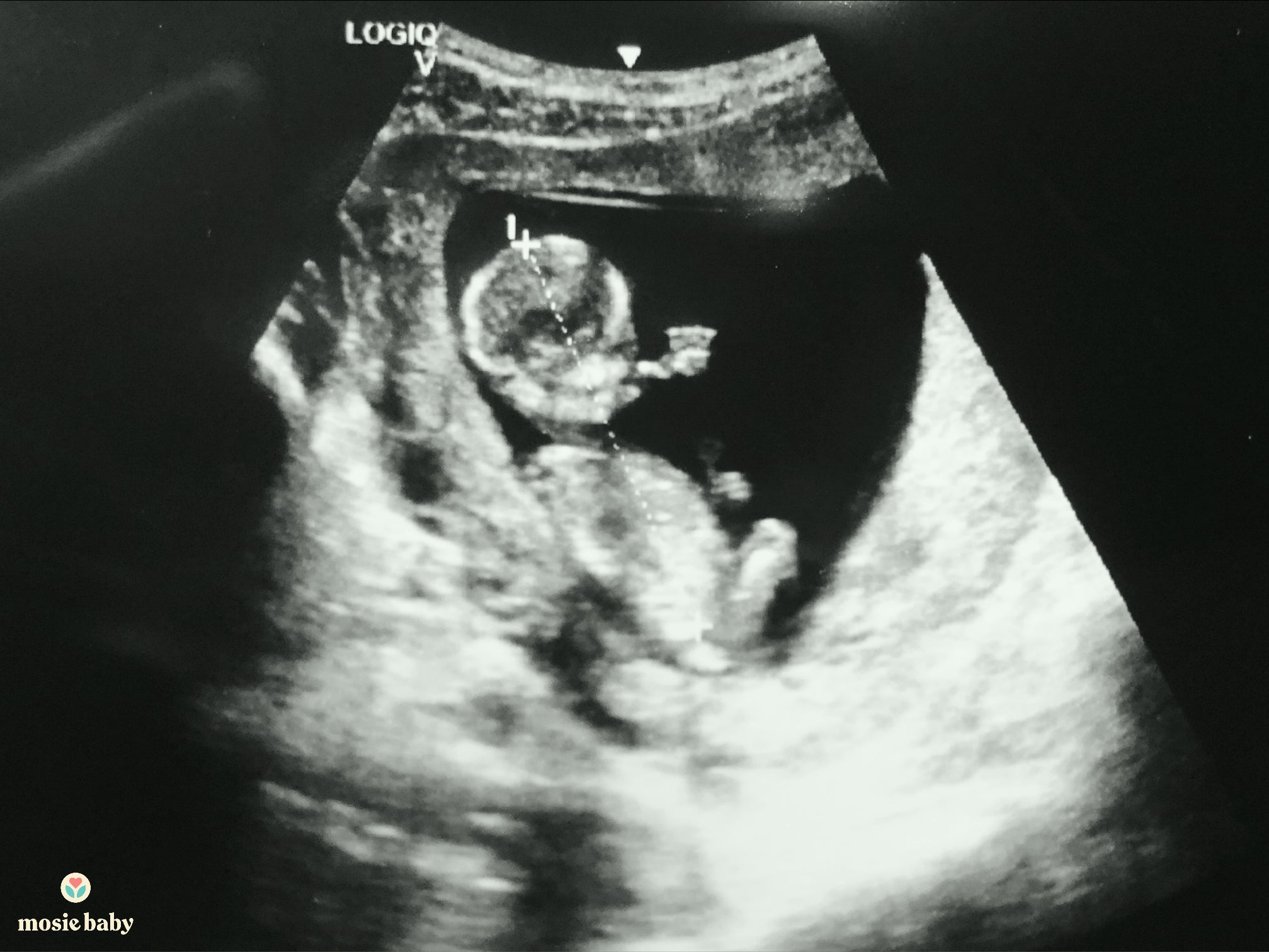 sonogram of a mosie baby