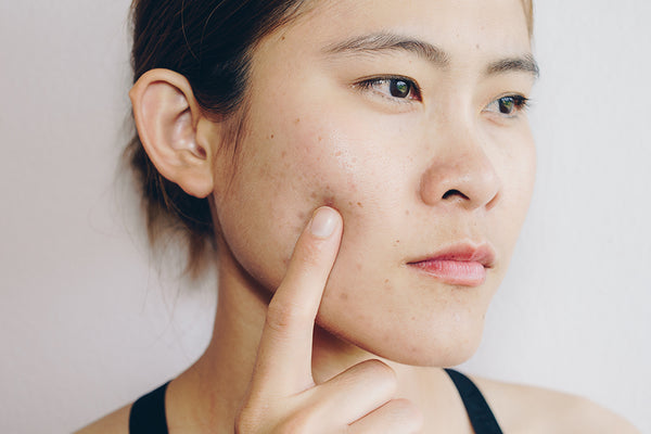 woman with acne