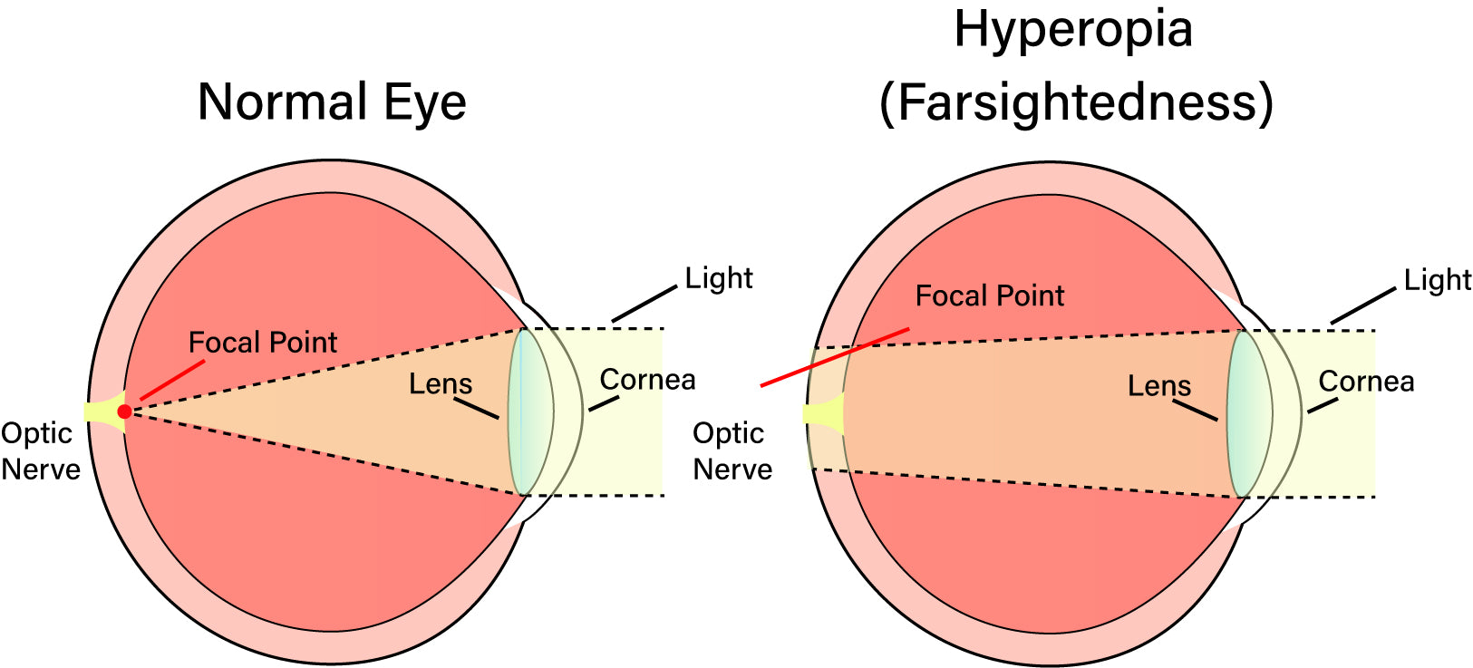 vision bad eye considered