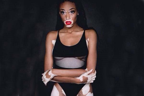Authentic Beauty- Chantelle Brown-Young_model_body image_fashion_photography_vitiligo_article_Kids of Dada