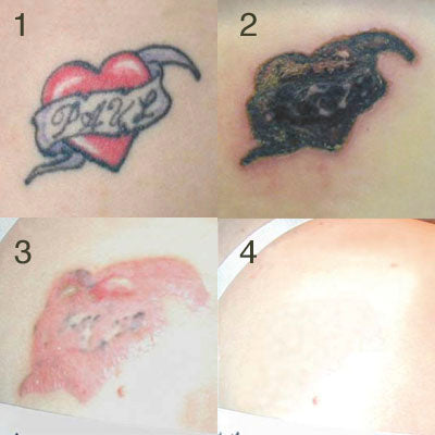 original tattoo treated tattoo a week after treatment a thick