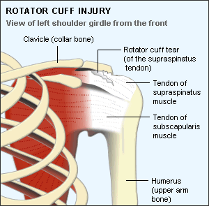shoulder tear injury