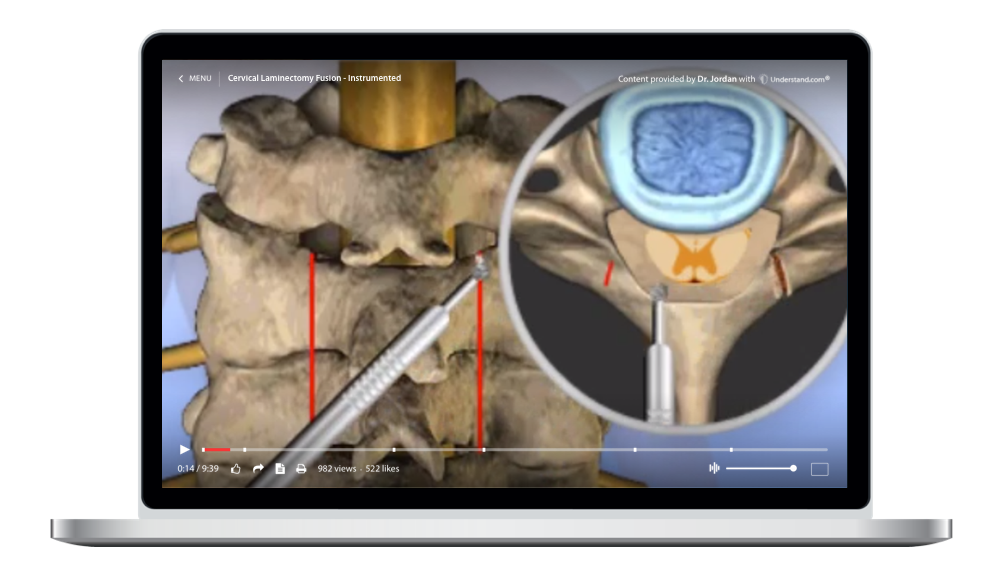 Cervical Cervical Laminectomy Fusion Instrumented Animation 8265