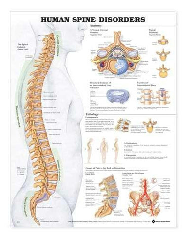 Picture of Human Spine Disorders Anatomical Chart 20 x 26