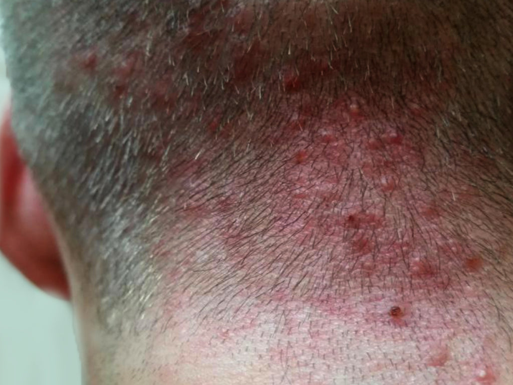 folliculitis forehead