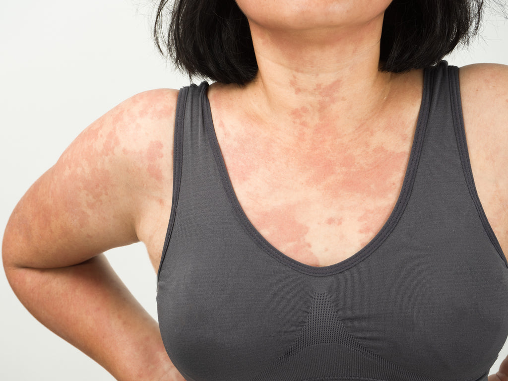 Can Anxiety Causes Rashes