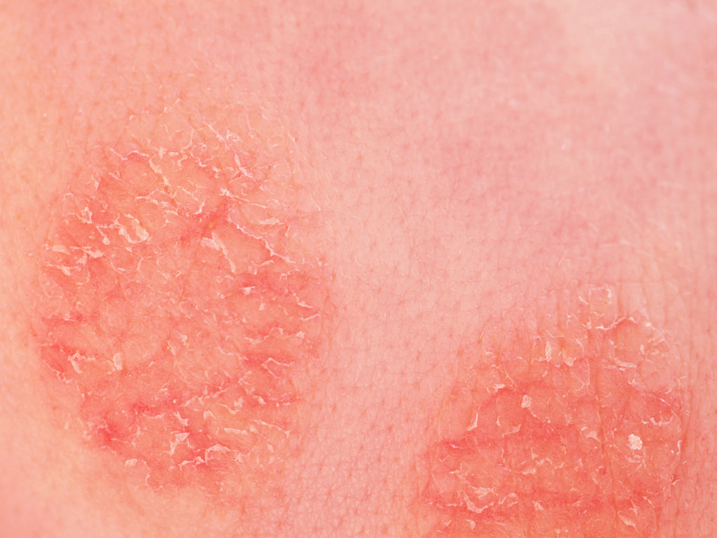 Does Discoid Eczema Leave Scars? Balmonds