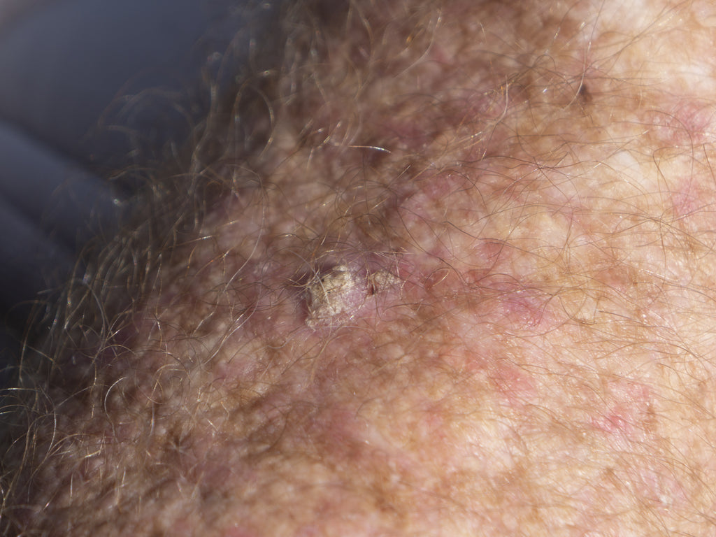 What Does Actinic Keratosis Look Like Balmonds