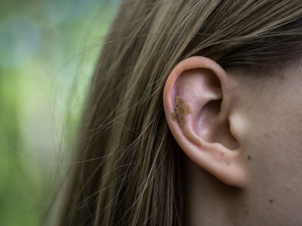 Is My Ear Eczema Infected The Signs And Symptoms Of Aural Dermatitis Balmonds