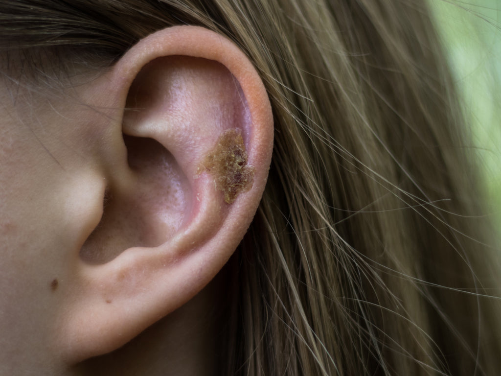 what-causes-scabs-in-my-ear-balmonds