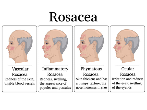 types of rosacea