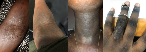 post-inflammatory hyperpigmentation