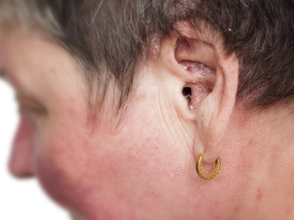 eczema in the ear