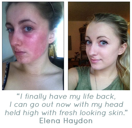 Purepotions customer Elena Haydon - How Skin Salvation worked for her