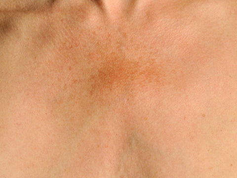Hyperpigmentation on white skin